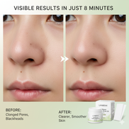 Blackhead Remover Mask – Deep Cleansing & Pore Purifying